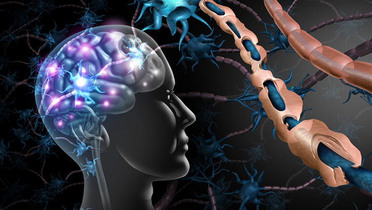 Multiple sclerosis nerve disorder and damaged myelin with 3D illustration.  NUI Galway
